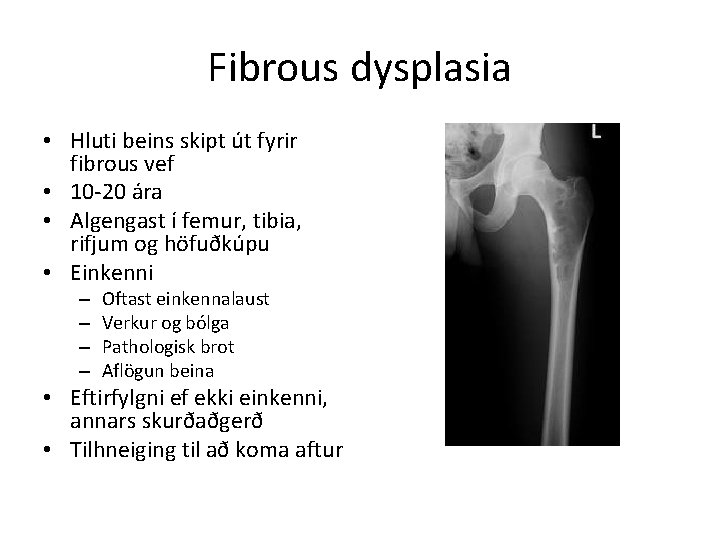 Fibrous dysplasia • Hluti beins skipt út fyrir fibrous vef • 10 -20 ára