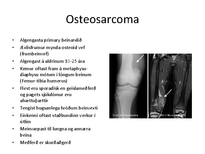 Osteosarcoma • • • Algengasta primary beinæxlið Æxlisfrumur mynda osteoid vef (frumbeinvef) Algengast á