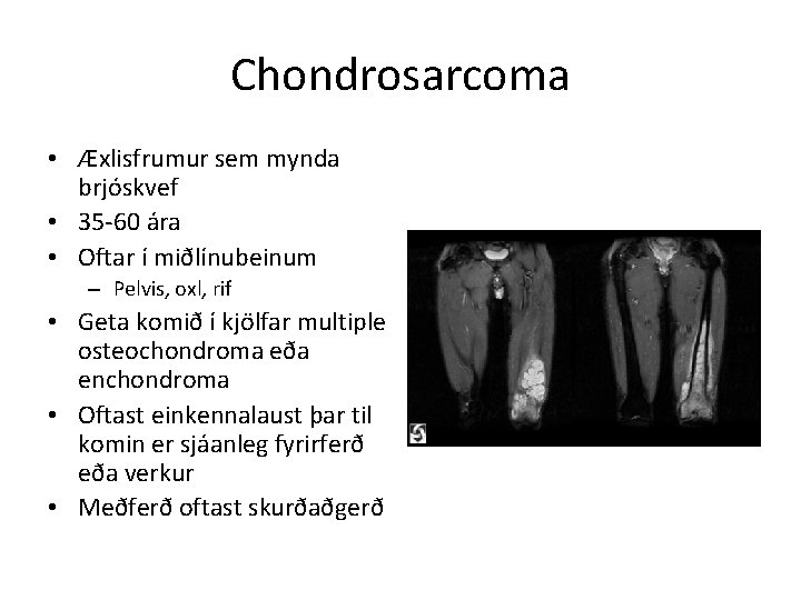 Chondrosarcoma • Æxlisfrumur sem mynda brjóskvef • 35 -60 ára • Oftar í miðlínubeinum