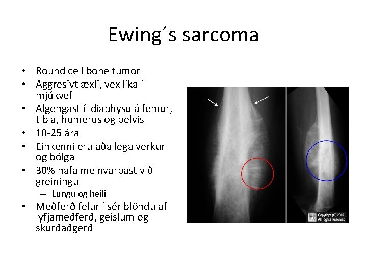 Ewing´s sarcoma • Round cell bone tumor • Aggresivt æxli, vex líka í mjúkvef