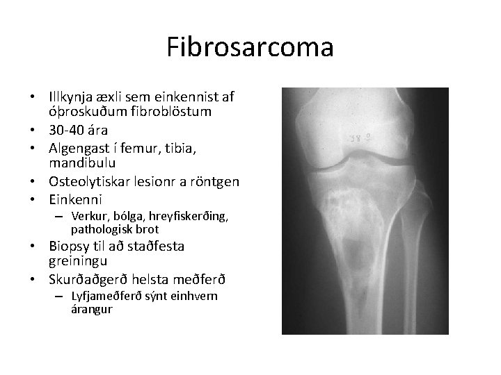 Fibrosarcoma • Illkynja æxli sem einkennist af óþroskuðum fibroblöstum • 30 -40 ára •