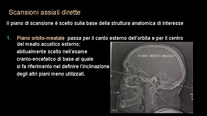 Scansioni assiali dirette Il piano di scansione è scelto sulla base della struttura anatomica