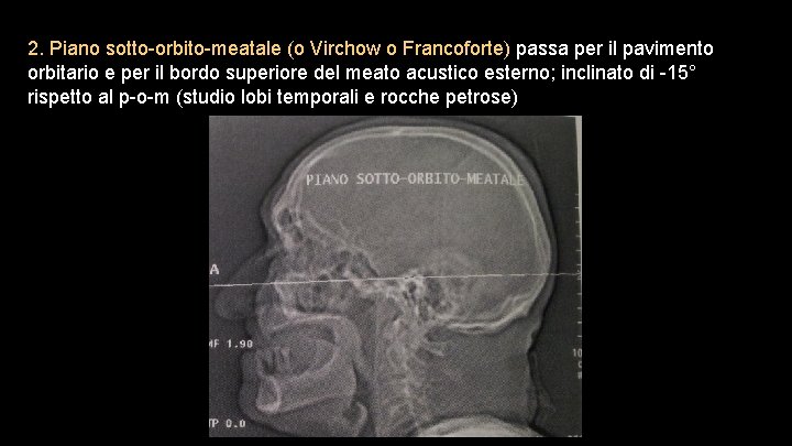 2. Piano sotto-orbito-meatale (o Virchow o Francoforte) passa per il pavimento orbitario e per