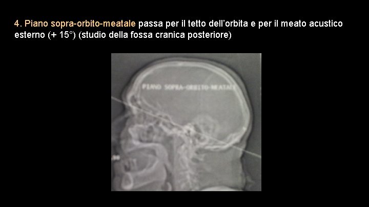 4. Piano sopra-orbito-meatale passa per il tetto dell’orbita e per il meato acustico esterno