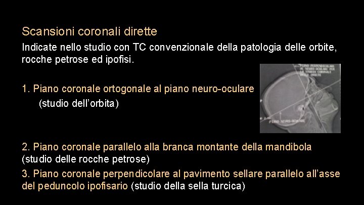 Scansioni coronali dirette Indicate nello studio con TC convenzionale della patologia delle orbite, rocche