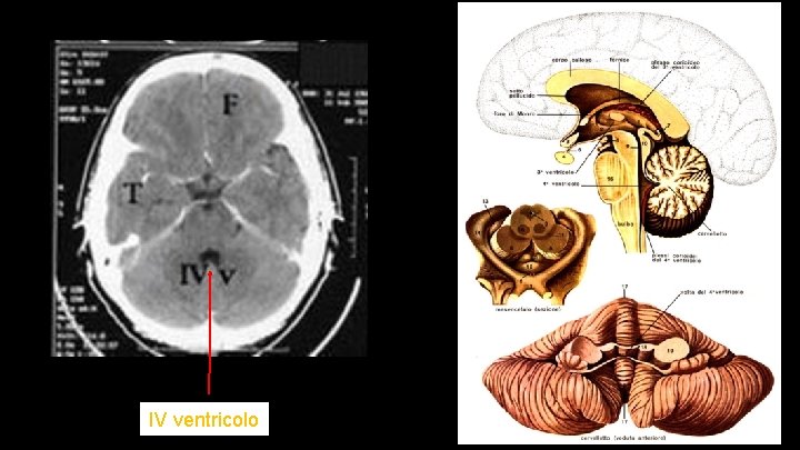 IV ventricolo 