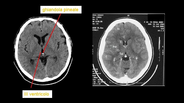 ghiandola pineale III ventricolo 