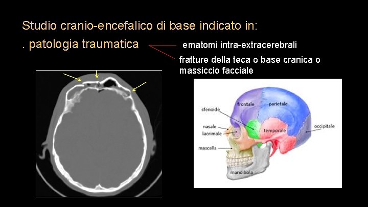 Studio cranio-encefalico di base indicato in: . patologia traumatica ematomi intra-extracerebrali fratture della teca