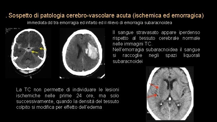 . Sospetto di patologia cerebro-vascolare acuta (ischemica ed emorragica) immediata dd tra emorragia ed