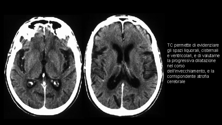 TC permette di evidenziare gli spazi liquorali, cisternali e ventricolari, e di valutarne la