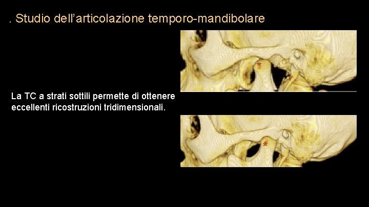 . Studio dell’articolazione temporo-mandibolare La TC a strati sottili permette di ottenere eccellenti ricostruzioni