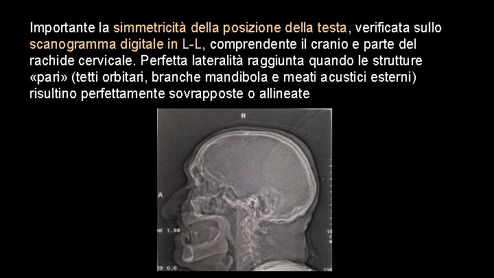 Importante la simmetricità della posizione della testa, verificata sullo scanogramma digitale in L-L, comprendente