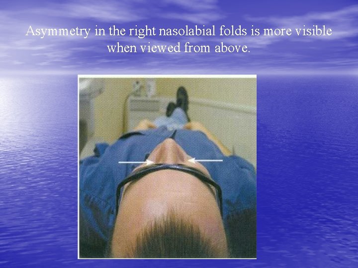 Asymmetry in the right nasolabial folds is more visible when viewed from above. 