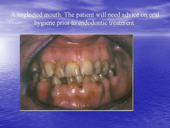 A neglected mouth. The patient will need advice on oral hygiene prior to endodontic