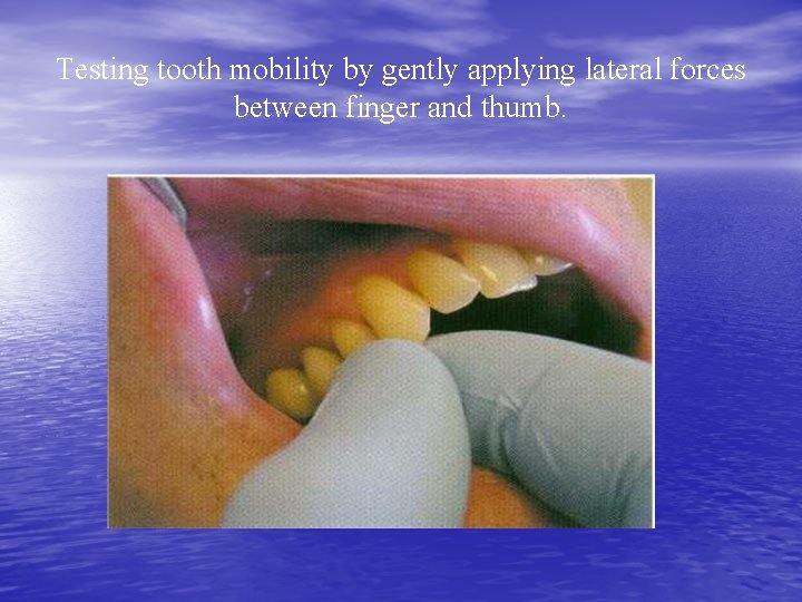 Testing tooth mobility by gently applying lateral forces between finger and thumb. 