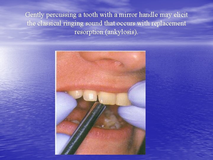 Gently percussing a tooth with a mirror handle may elicit the classical ringing sound