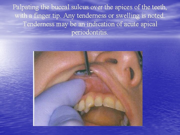 Palpating the buccal sulcus over the apices of the teeth, with a finger tip.