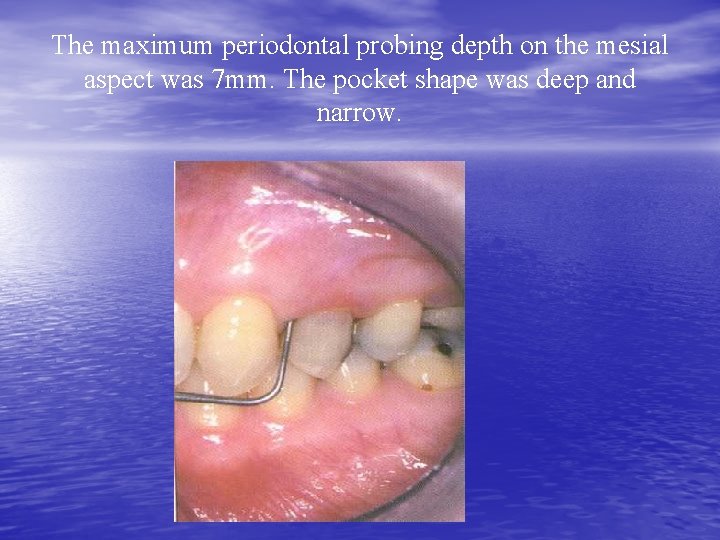 The maximum periodontal probing depth on the mesial aspect was 7 mm. The pocket