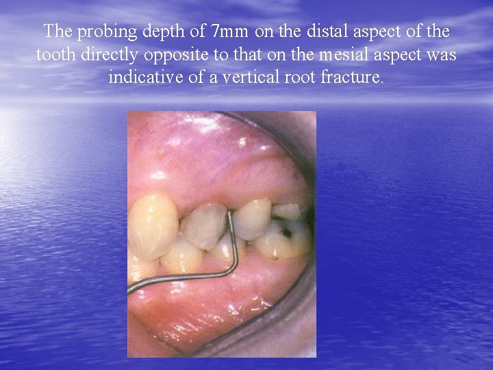The probing depth of 7 mm on the distal aspect of the tooth directly