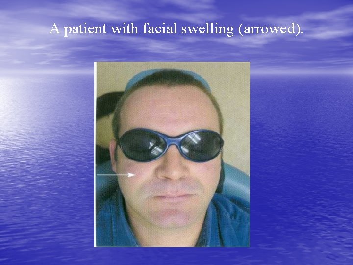 A patient with facial swelling (arrowed). 