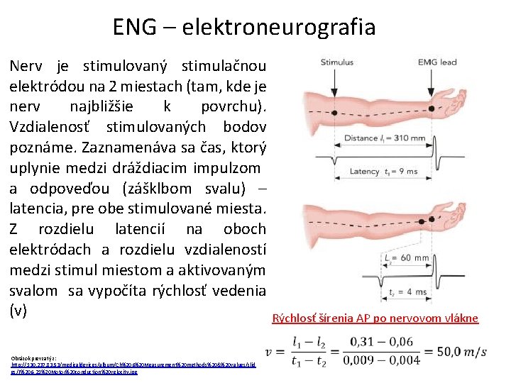 ENG – elektroneurografia Nerv je stimulovaný stimulačnou elektródou na 2 miestach (tam, kde je