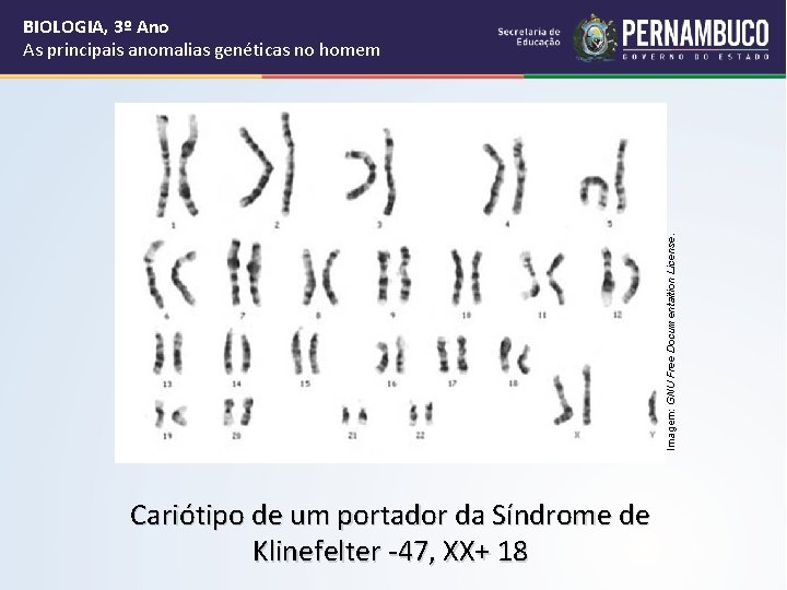 Imagem: GNU Free Documentaition License. BIOLOGIA, 3º Ano As principais anomalias genéticas no homem