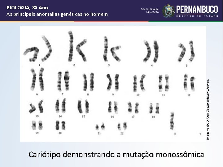 Imagem: GNU Free Documentation License. BIOLOGIA, 3º Ano As principais anomalias genéticas no homem