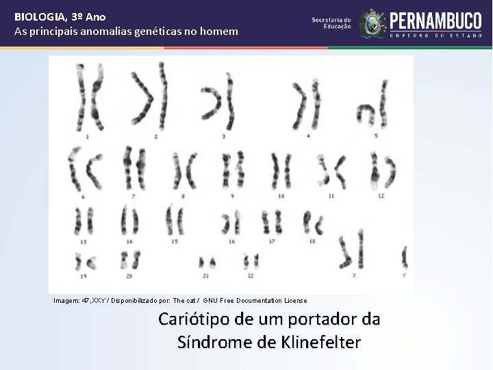 BIOLOGIA, 3º Ano As principais anomalias genéticas no homem Imagem: 47, XXY / Disponibilizado