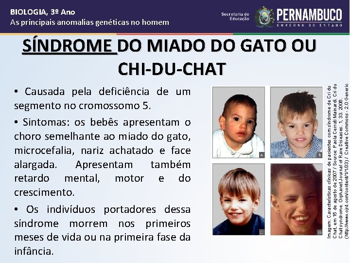 BIOLOGIA, 3º Ano As principais anomalias genéticas no homem • Causada pela deficiência de