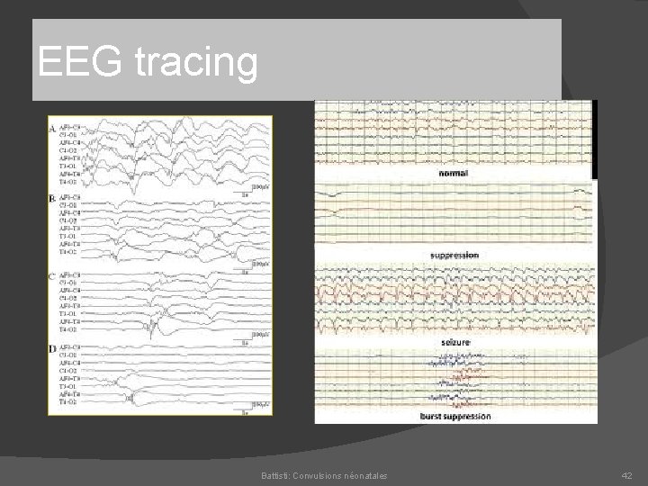 EEG tracing Battisti: Convulsions néonatales 42 