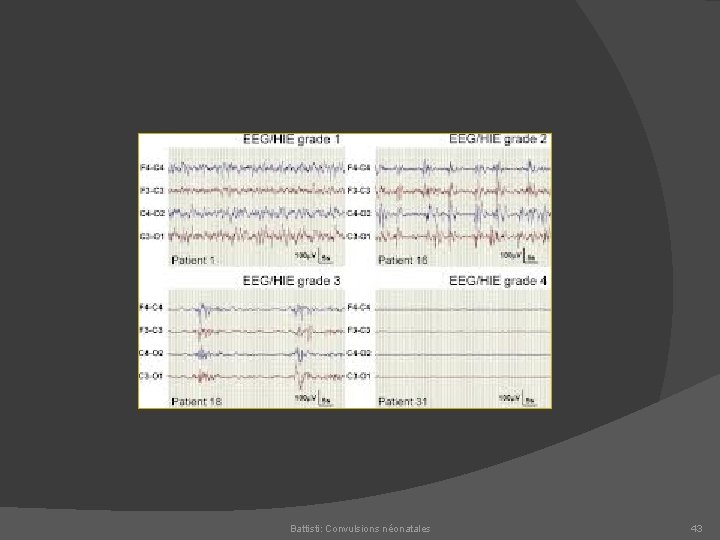 Battisti: Convulsions néonatales 43 