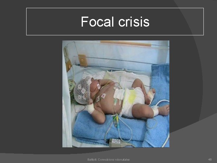 Focal crisis Battisti: Convulsions néonatales 46 