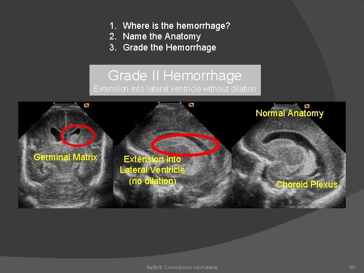 1. Where is the hemorrhage? 2. Name the Anatomy 3. Grade the Hemorrhage Grade