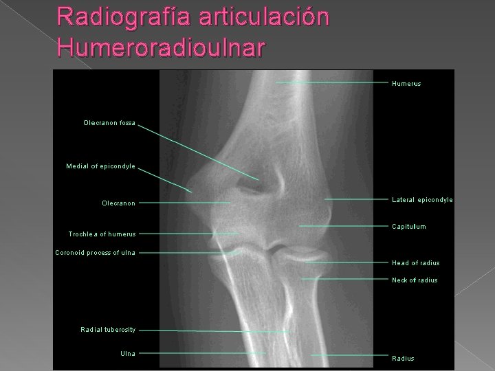 Radiografía articulación Humeroradioulnar 