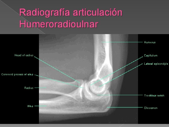 Radiografía articulación Humeroradioulnar 