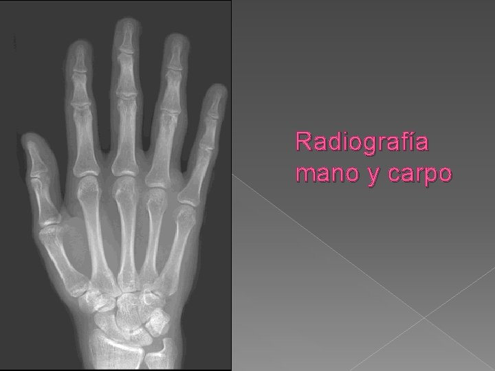 Radiografía mano y carpo 