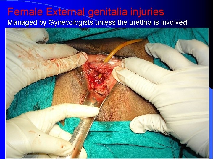 Female External genitalia injuries Managed by Gynecologists unless the urethra is involved 