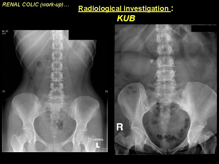 RENAL COLIC (work-up)… Radiological investigation : KUB 