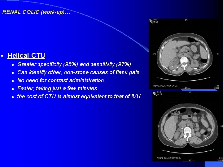 RENAL COLIC (work-up)… § Helical CTU l l l Greater specificity (95%) and sensitivity