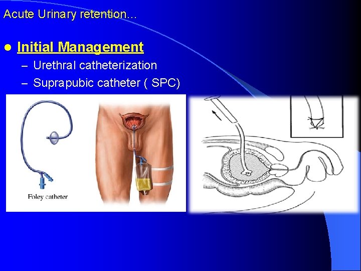 Acute Urinary retention… l Initial Management – Urethral catheterization – Suprapubic catheter ( SPC)