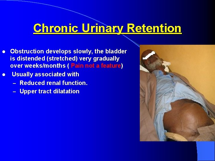 Chronic Urinary Retention Obstruction develops slowly, the bladder is distended (stretched) very gradually over
