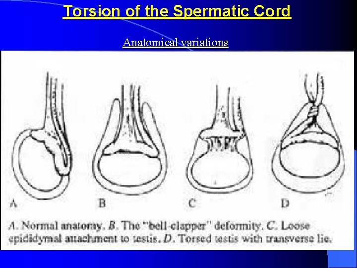 Torsion of the Spermatic Cord Anatomical variations 