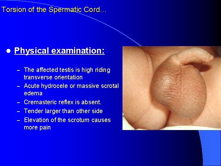 Torsion of the Spermatic Cord… l Physical examination: – The affected testis is high