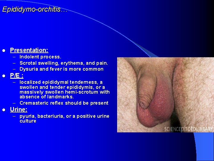 Epididymo-orchitis… l Presentation: – Indolent process. – Scrotal swelling, erythema, and pain. – Dysuria