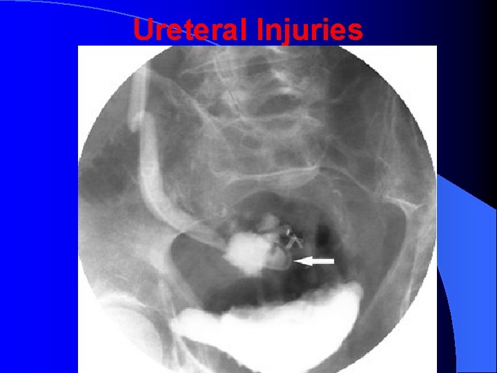 Ureteral Injuries 