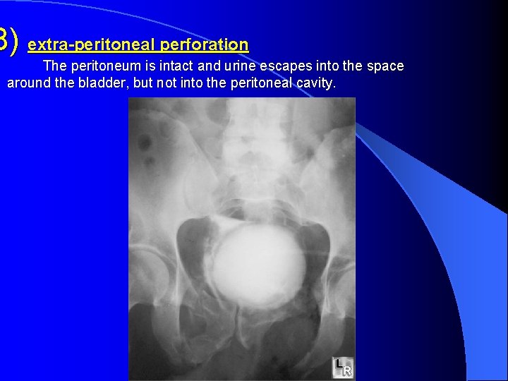 B) extra-peritoneal perforation The peritoneum is intact and urine escapes into the space around