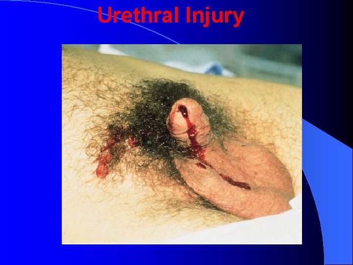 Urethral Injury 