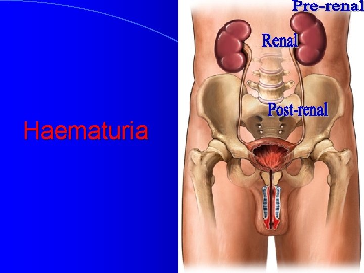 Haematuria 