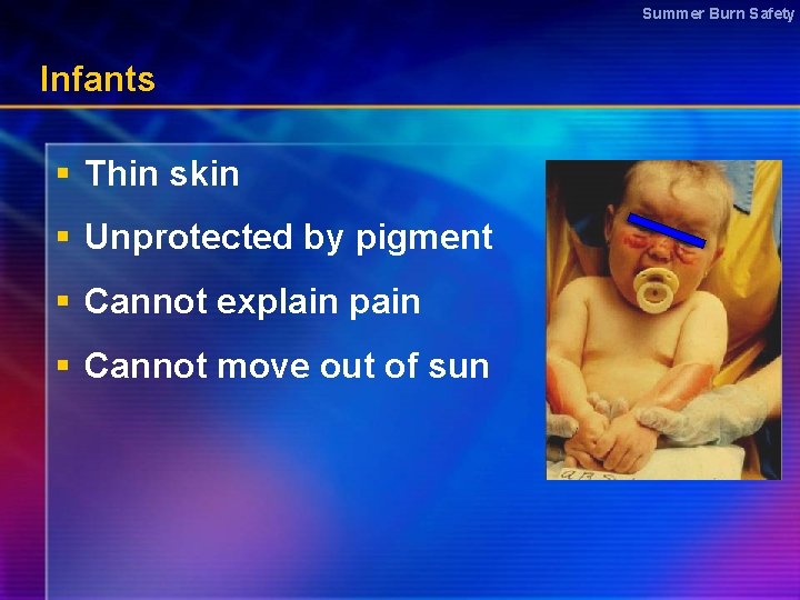 Summer Burn Safety Infants § Thin skin § Unprotected by pigment § Cannot explain