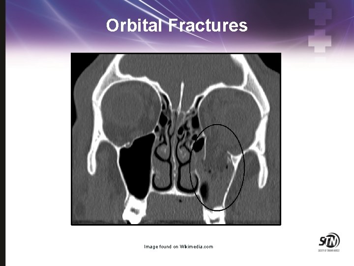 Orbital Fractures Image found on Wikimedia. com 